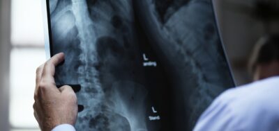 Densitometria óssea é recomendada no acompanhamento de pacientes bariátricos